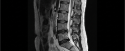 Ressonância magnética da coluna lombar evidenciando discos intervertebrais e canal medular.